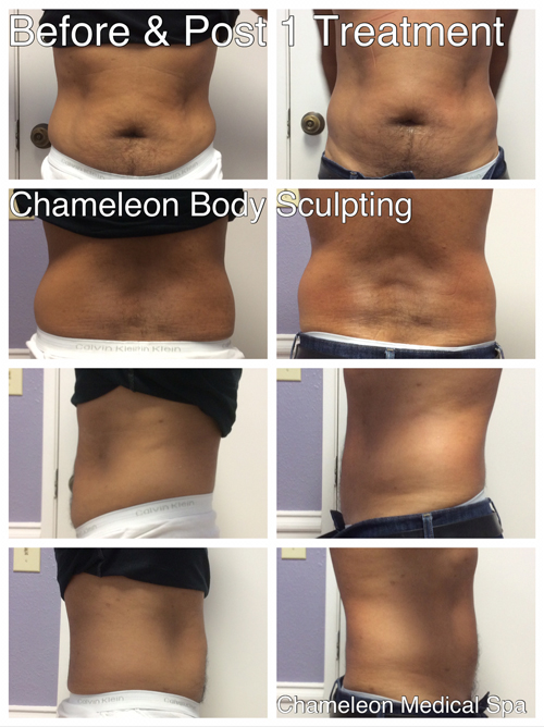 Body Skin Tightening, Before & After